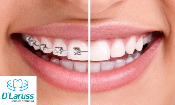 cadena transparente brackets san miguel brackets transparentes o met 225 licos y m 225 s cadena transparente brackets san miguel brackets transparentes o met 225 licos y m 225 s